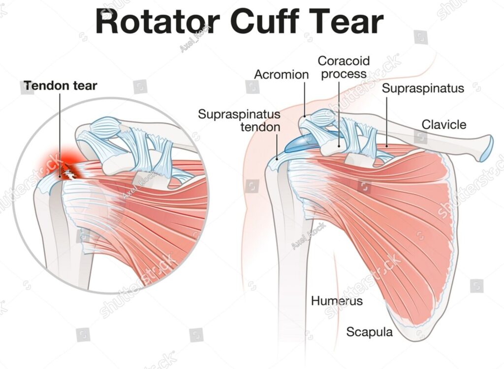 stock-photo-illustration-showing-rotator-cuff-tear-shoulder-illustration-2137557985