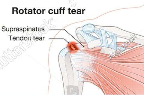 Lesione cuffia dei rotatori