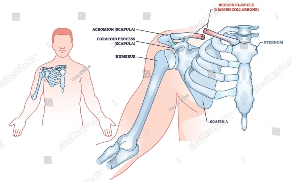 stock-vector-clavicle-fracture-anatomy-and-broken-shoulder-collarbone-outline-diagram-labeled-educational-2162918865 Dr. Giovanni Merolla