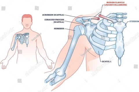 Fratture di clavicola