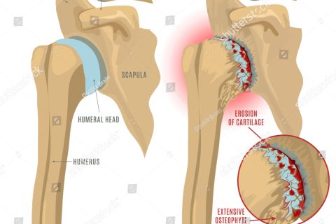 Artrosi e protesi di spalla