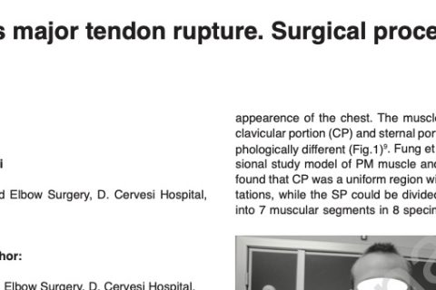 Pectoralis major tendo rupture surgical procedures review