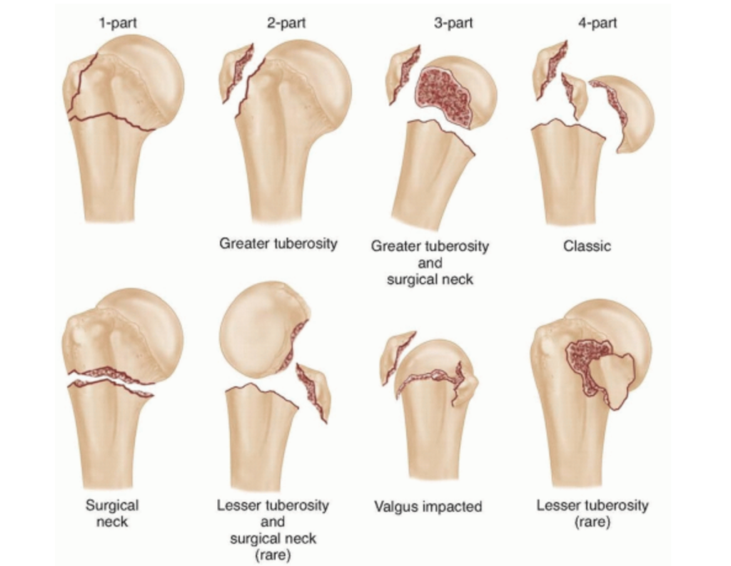 Omero prossimale: collo anatomico, collo chirurgico, grande e piccola tuberosità secondo Neer