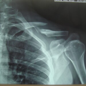 Frattura scomposta a 3 frammenti del corpo della clavicola al terzo medio Frattura scomposta a 3 frammenti del corpo della clavicola al terzo medio
