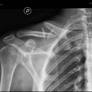Frattura scomposta a 4 frammenti del corpo della clavicola al terzo medio Frattura scomposta a 4 frammenti del corpo della clavicola al terzo medio