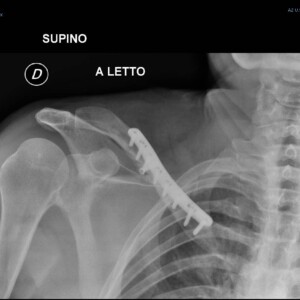 Sintesi interna com placca e viti Sintesi interna com placca e viti