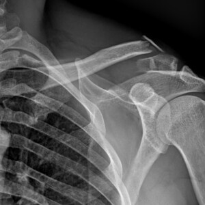 Frattura scomposta del terzo laterale della clavicola Frattura scomposta del terzo laterale della clavicola