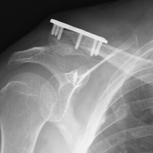 Sintesi interna con placca di frattura del terzo laterale di clavicola Sintesi interna con placca di frattura del terzo laterale di clavicola