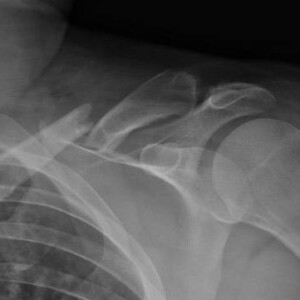 Frattura scomposta del corpo della clavicola al terzo medio-laterale Frattura scomposta del corpo della clavicola al terzo medio-laterale