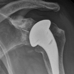 Protesi totale anatomica a stelo corto con componente glenoidea in polietilene