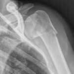 Radiografia di frattura pluriframmentaria dell'omero prossimale prima dell'intervento