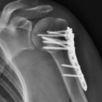 Radiografia a due mesi dalla sintesi con placca e viti di una frattura dell'omero prossimale