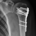 Radiografia a un anno: frattura dell'omero prossimale consolidata