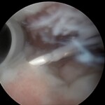 Radiografia di frattura pluriframmentaria dell'omero prossimale prima dell'intervento