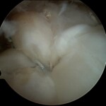 Radiografia a due mesi dalla sintesi con placca e viti di una frattura dell'omero prossimale